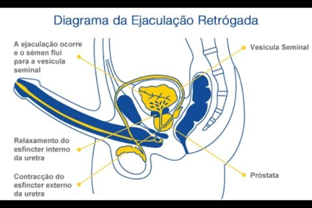 Ejaculação Precoce